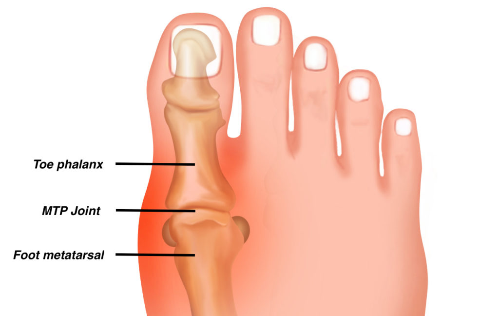 Great toe pain RunBionic